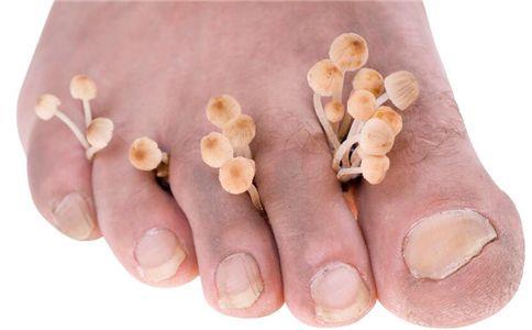 腳氣怎么根治，治療腳氣的十大注意事項[漓峰消毒]